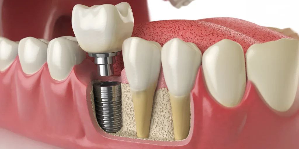 ایمپلنت دندان: کلید لبخندی زیبا و اعتماد به نفس
