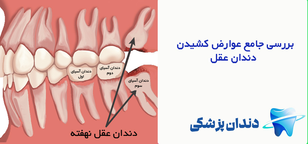 بررسی جامع عوارض کشیدن دندان عقل