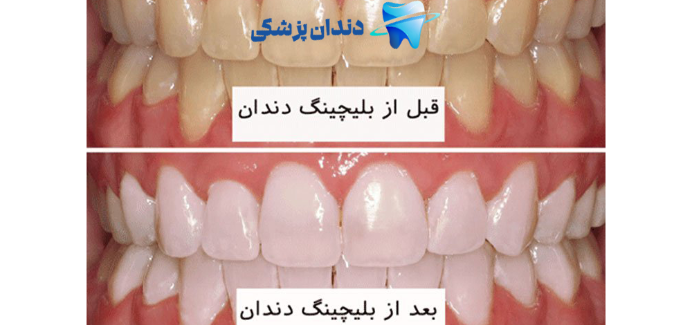 بلیچ دندان چیست: