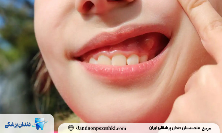 درمان خانگی کیست دندان