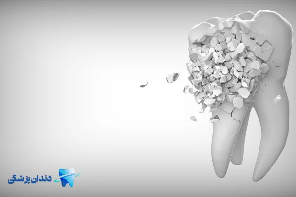 دلایل عفونت دندان در بارداری چیست؟