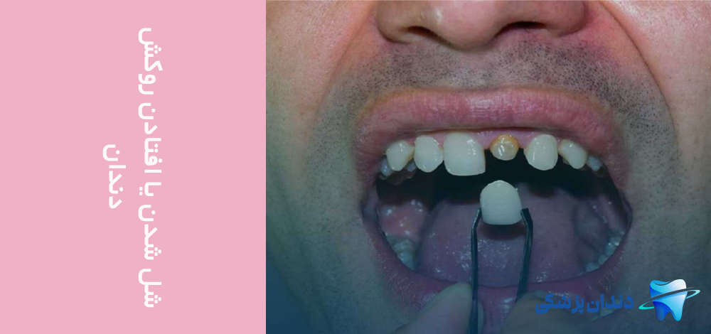 شل شدن یا افتادن روکش دندان