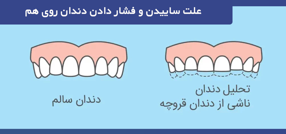 علت ساییدن و فشار دادن دندان روی هم