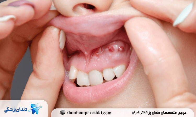 درمان کیست دندان