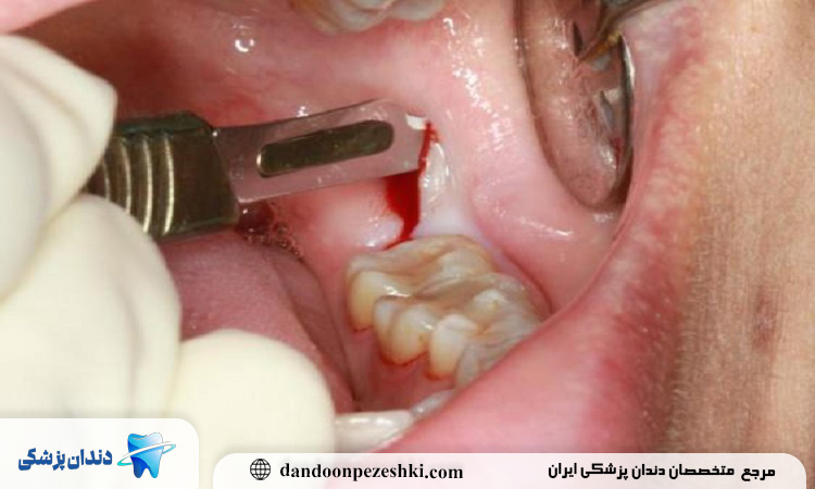 پیشگیری از کیست دندان