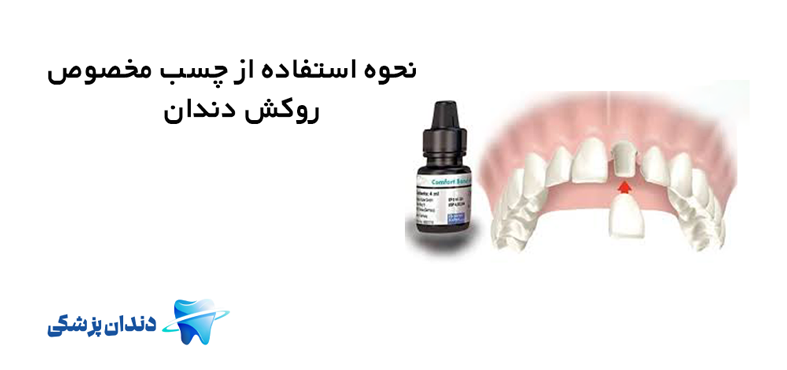 نحوه استفاده از چسب مخصوص روکش دندان