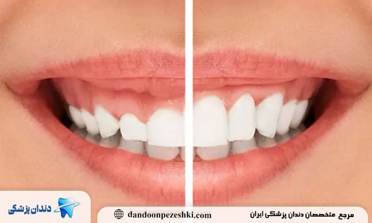 اصلاح لبخند لثه ای