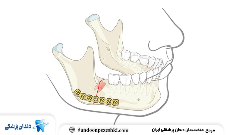 جراحی دندان شکسته