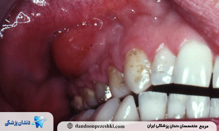 آبسه دندان عقل چه علائمی دارد و چگونه درمان می‌شود؟