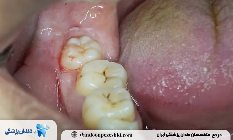 آبسه دندان عقل چیست و چرا بیشتر در دندانهای عقل بروز میکند؟