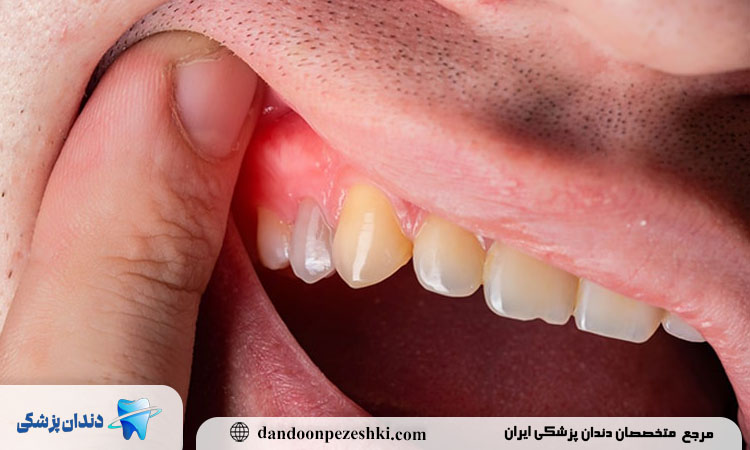 آیا می‌توان از بروز آبسه دندان عقل جلوگیری کرد؟ راهکارهای پیشگیرانه چیست؟