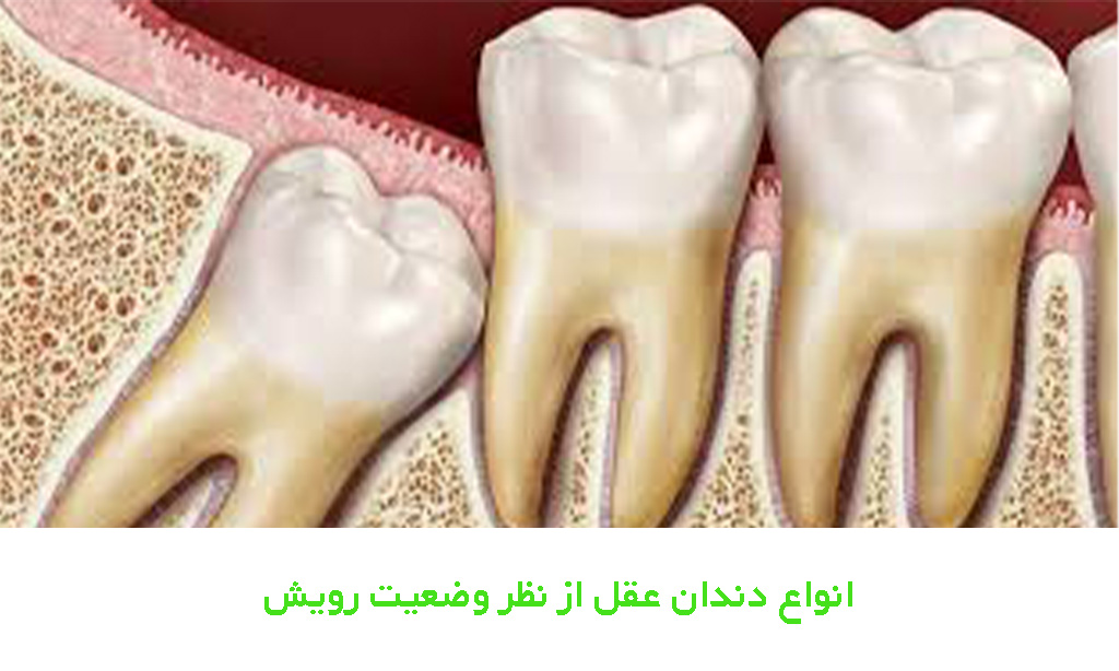 انواع دندان عقل از نظر وضعیت رویش؛ نهفته، نیمه نهفته یا کاملاً روییده؟