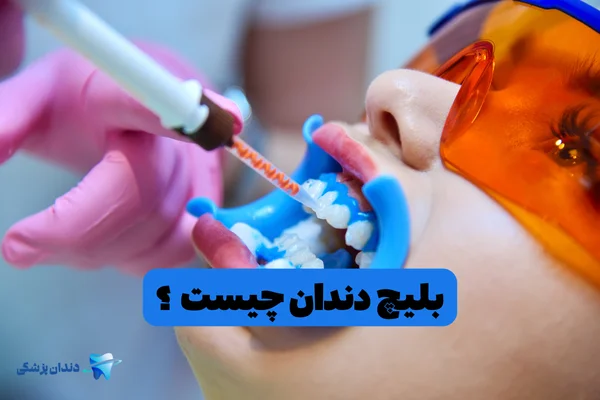 بلیچ دندان چیست ؟