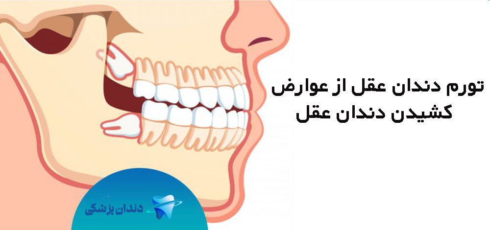 تورم دندان عقل از عوارض کشیدن دندان عقل