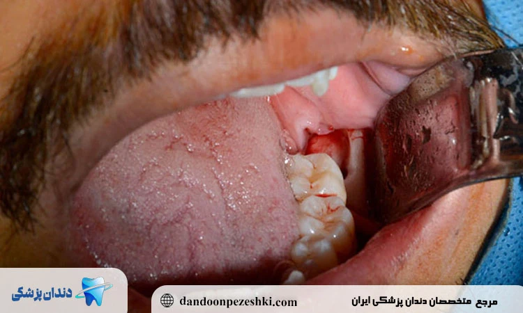 جراحی دندان عقل چه خطرات و عوارضی دارد