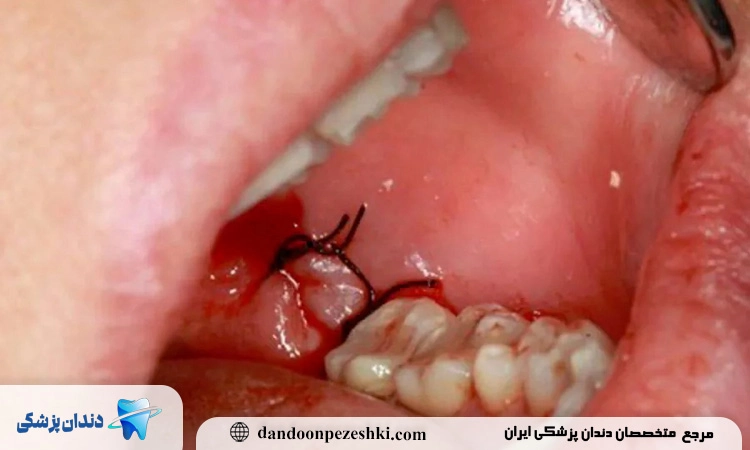 جراحی دندان عقل چیست