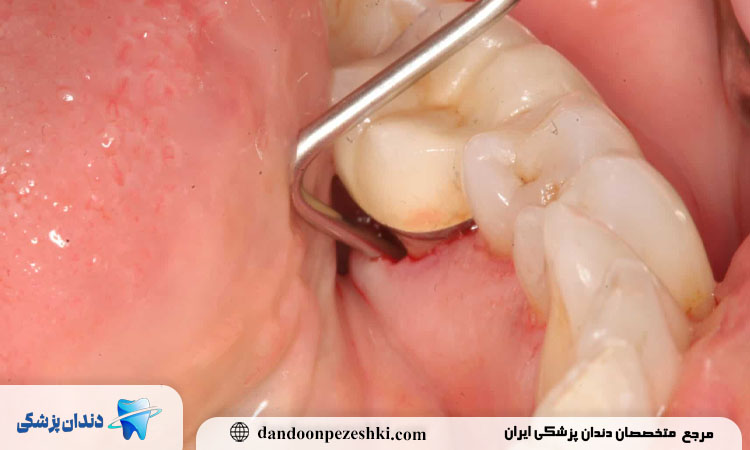 درمان آبسه دندان عقل چگونه انجام می‌شود و چه رویکردهایی برای آن وجود دارد؟