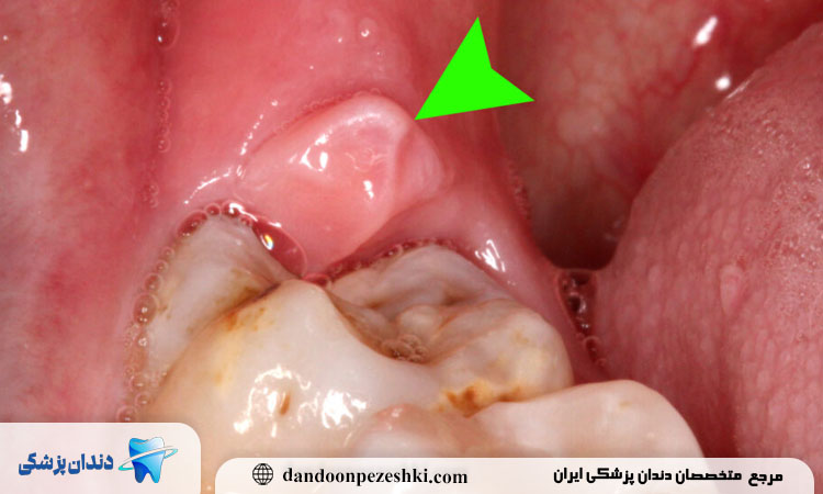 روش‌های تشخیص آبسه دندان عقل توسط دندانپزشک یا جراح فک