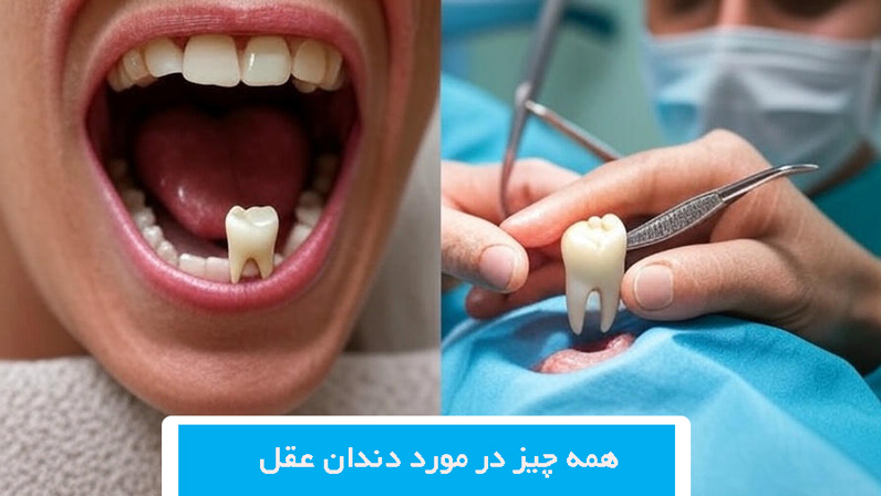 همه چیز در مورد دندان عقل؛ از رویش تا جراحی و مراقبت‌های پس از آن