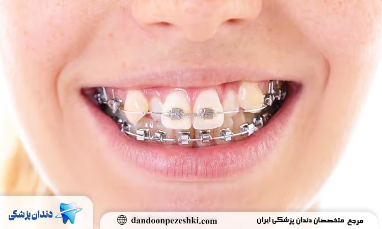 ارتودنسی دندان خرگوشی