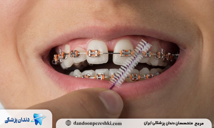 ارتودنسی دندان فاصله دار