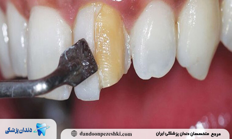 آیا امکان ترمیم کامپوزیت‌های قدیمی وجود دارد یا باید کاملاً تعویض شوند؟