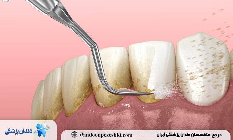 آیا نیاز به مراجعه مجدد به دندانپزشک بعد از جرم‌گیری وجود دارد؟