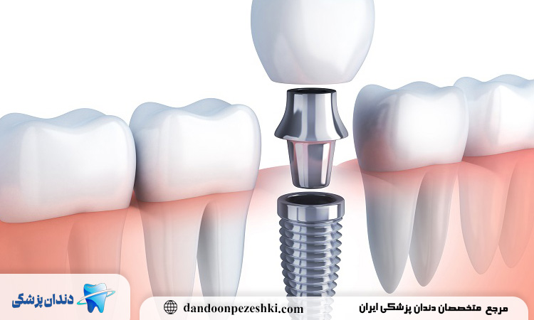 آیا همه افراد می‌توانند کاشت دندان انجام دهند یا نیاز به شرایط خاصی وجود دارد؟