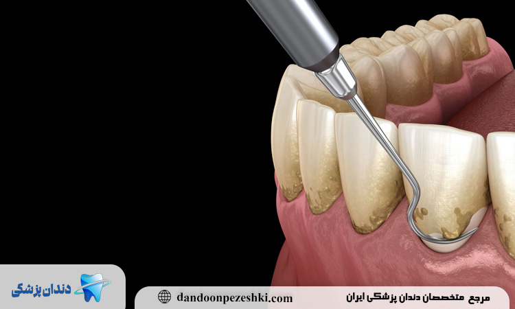 بلافاصله بعد از جرم‌گیری، چه واکنش‌هایی در دهان طبیعی هستند؟