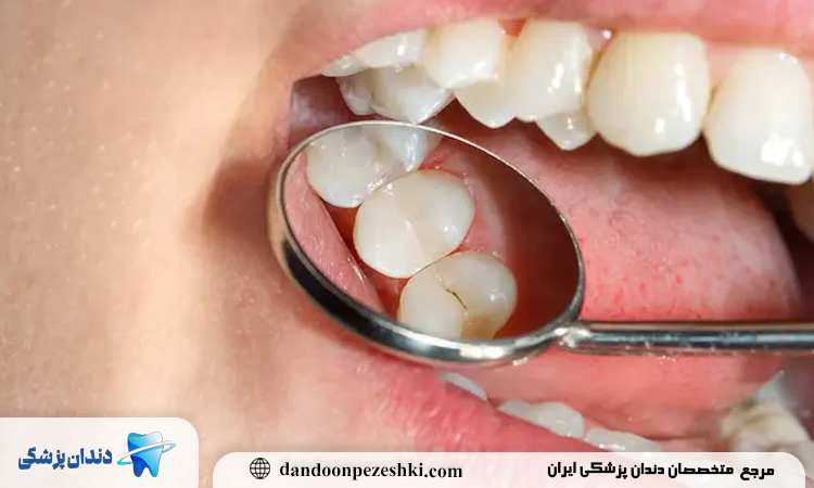 تفاوت در ساختار مینای دندان؛ چرا دندان شیری آسیبپذیرتر است؟