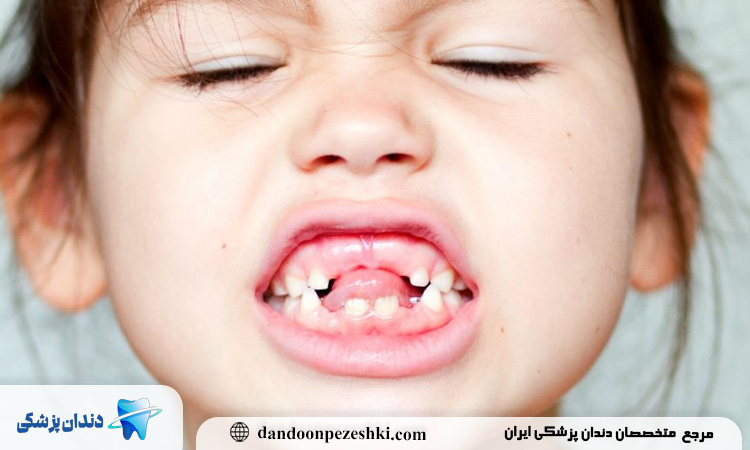 تفاوت در عملکرد دندان‌ها؛ دندان‌های شیری فقط جویدن نمی‌کنند!