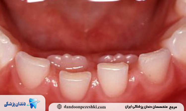 تفاوت زمان رویش دندان‌ها؛ دندان‌های شیری زودتر می‌آیند و زودتر می‌روند