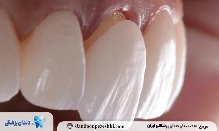 تفاوت طول عمر در انواع کامپوزیت: معمولی، نانو و هیبرید