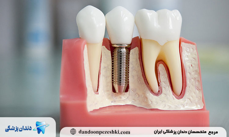 خدمات ایمپلنت دندان در تهرانسر