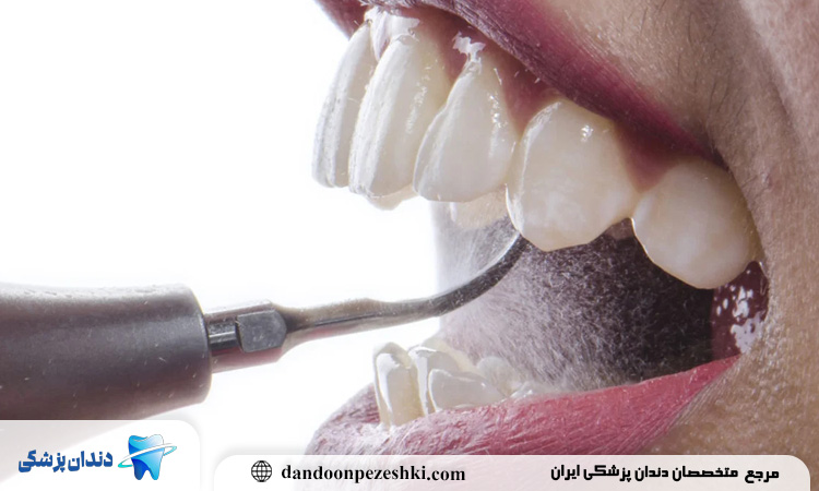 درد یا حساسیت بعد از جرم‌گیری طبیعی است؛ چگونه می‌توان آن را مدیریت کرد؟