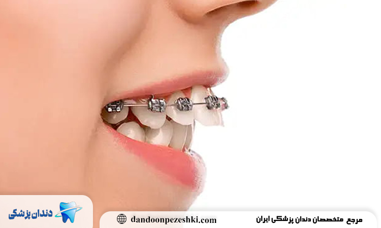 دلایل ایجاد دندان خرگوشی؛ از ژنتیک تا عادت‌های رفتاری نادرست
