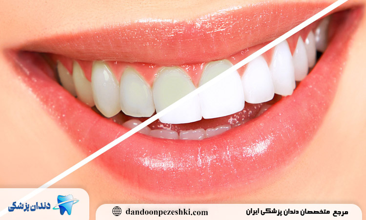 طول عمر کامپوزیت دندان در حالت استاندارد چقدر است و چه عواملی آن را تعیین می‌کند؟