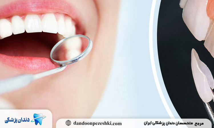 طول عمر کامپوزیت دندان چقدر است؟