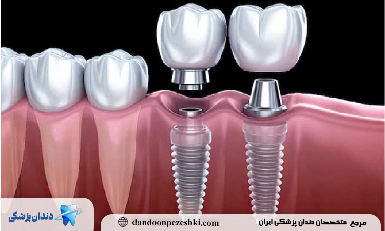 قالب گیری ایمپلنت دندان چیست و چرا در موفقیت نهایی کاشت دندان اهمیت دارد؟