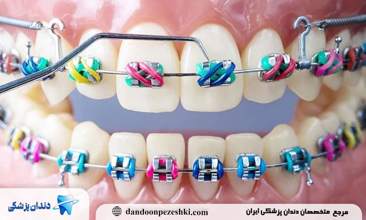 مراقبت‌های بعد از درمان ارتودنسی برای حفظ نتایج چیست؟