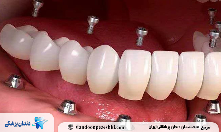 مراقبت‌های بعد از کاشت دندان؛ چطور عمر ایمپلنت را افزایش دهیم؟