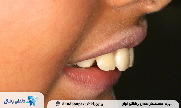 معایب احتمالی ارتودنسی دندان خرگوشی و راهکارهایی برای مدیریت آن‌ها