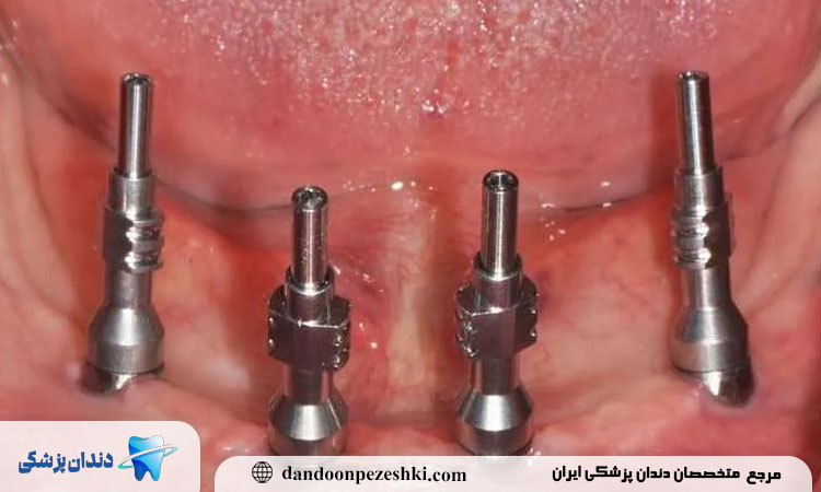 معرفی دقیق مراحل قالب گیری ایمپلنت دندان؛ از اتصال قطعه تا برداشت نهایی