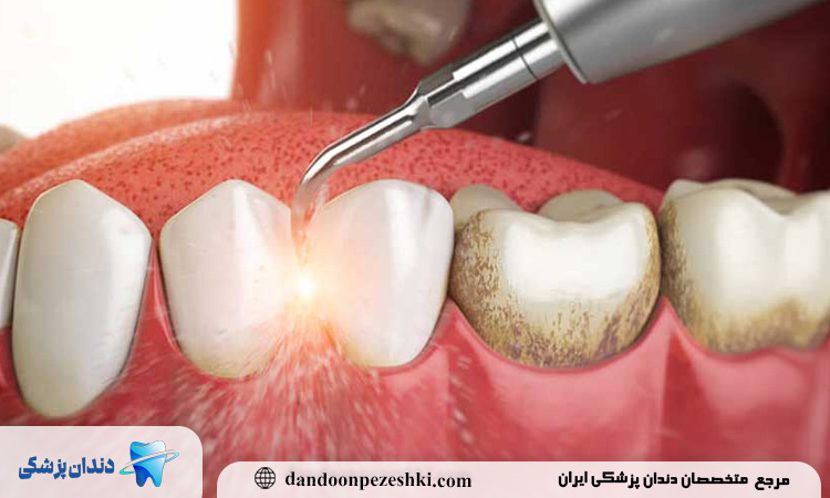نکاتی برای حفظ نتیجه جرم‌گیری در بلندمدت و کاهش نیاز به تکرار درمان