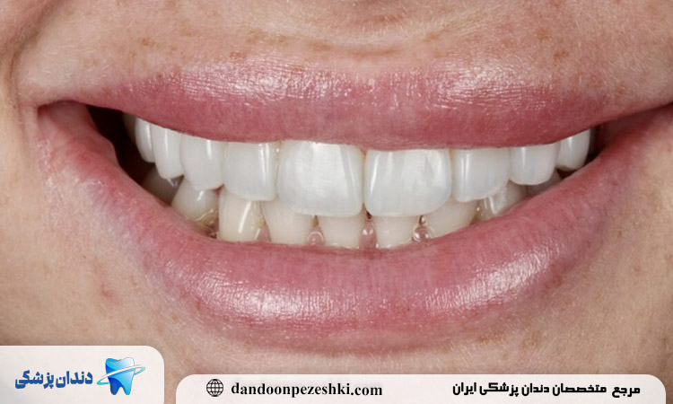 چرا باید به بهترین دکتر کامپوزیت دندان مراجعه کرد؟