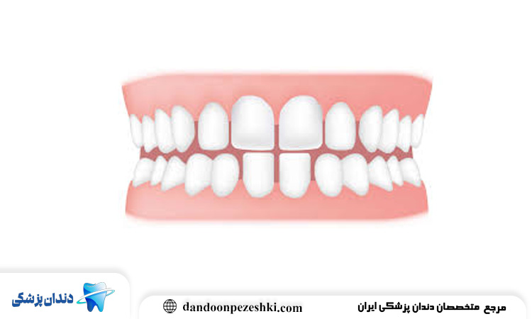 چرا برخی افراد دندان‌هایشان از هم فاصله دارد و این فاصله چگونه ایجاد می‌شود؟