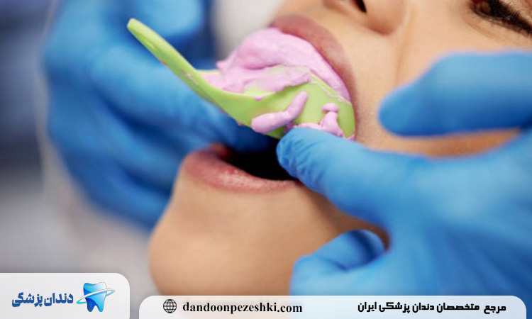 چرا دندانپزشکان حرفه‌ای به مرحله قالب گیری اهمیت زیادی می‌دهند؟
