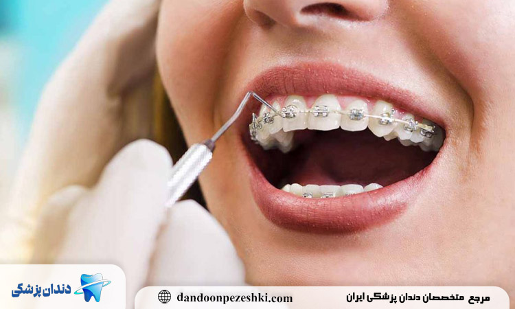 چند نکته مهم که قبل از شروع ارتودنسی دندان فاصله دار باید بدانید
