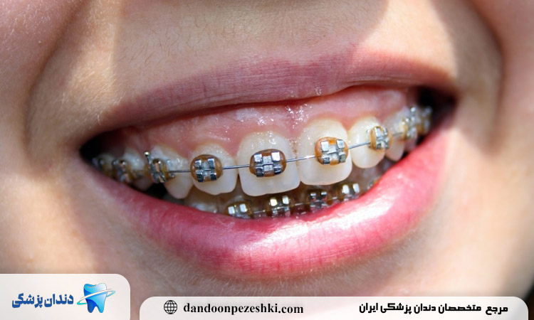 چه انتظاراتی باید از درمان ارتودنسی دندان خرگوشی داشته باشیم؟