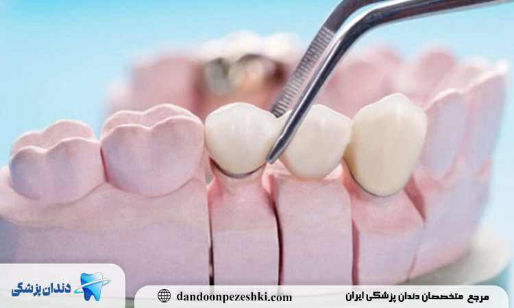 چه موادی در قالب گیری ایمپلنت دندان استفاده می‌شود و چرا دقت آن‌ها حیاتی است؟